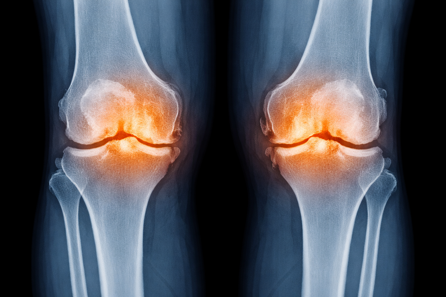 Kniearthrose als Berufskrankheit: Voraussetzungen, Urteil & Chancen für BKF